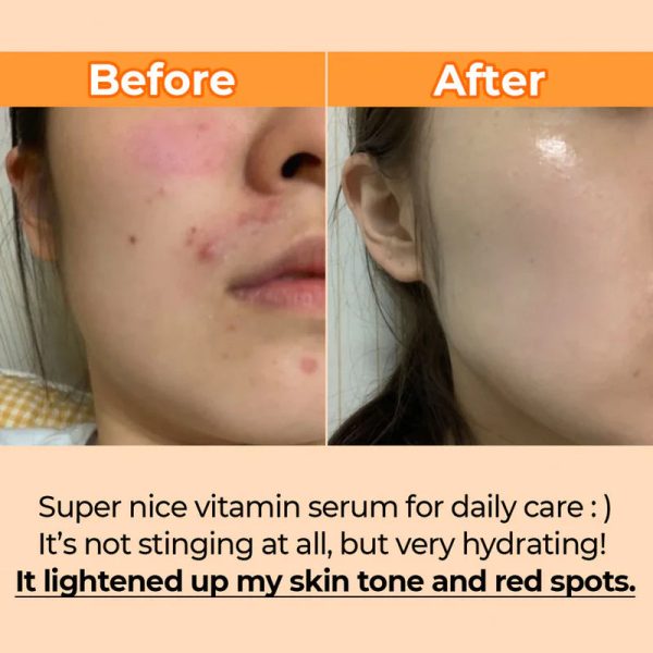 NUMBUZIN 5 goodby blemish serum سيروم علاج التهيج من نمبوزين Online Hot Sale